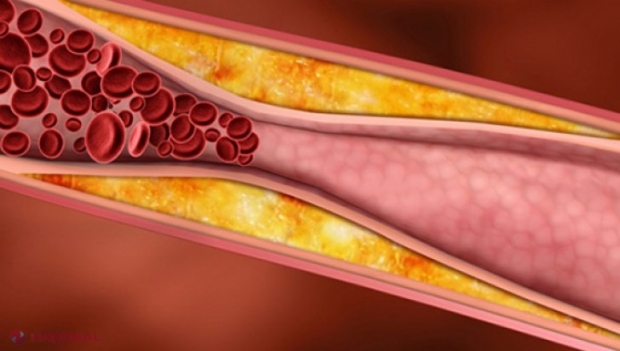 Semne SILENŢIOASE care îţi spun că ai arterele înfundate şi că rişti afecţiuni grave