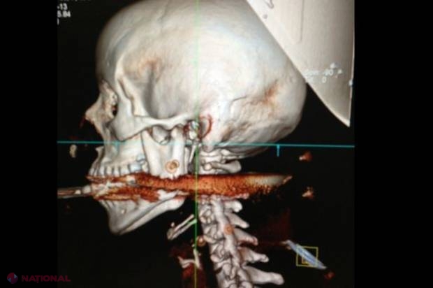 FOTO // Medicii au fost frapaţi: Cu ce a rămas o FEMEIE în gură după o greşeală a SOŢULUI   