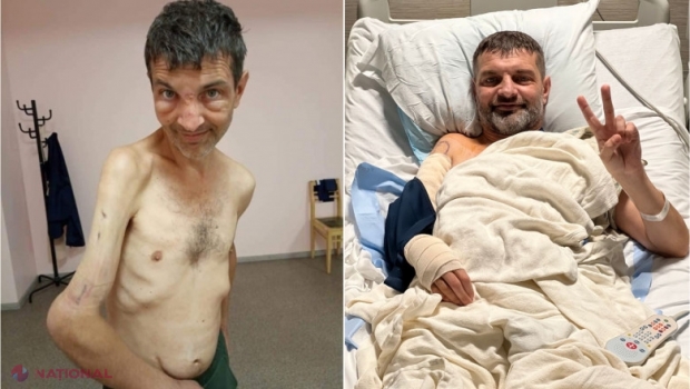 FOTO // Cum arată luptătorul de la Azovstal căruia rușii i-au smuls cu clești dispozitivul care-i fixa brațul. Mihailo a fost operat în SUA