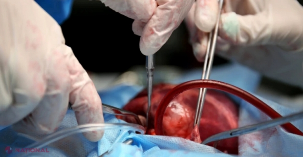 Două inimi de porc, transplantate cu succes la pacienți umani aflați în moarte cerebrală