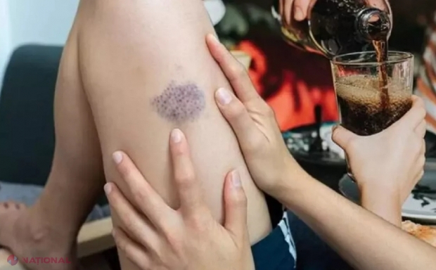 Avertisment privind cheagurile de sânge: Evitați aceste trei băuturi! Duc la blocarea arterelor!