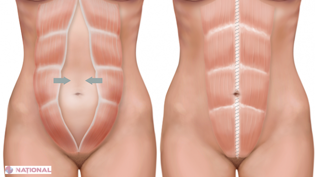 Cum să scapi de BURTICĂ într-o zi. 15 IDEI MINUNE!
