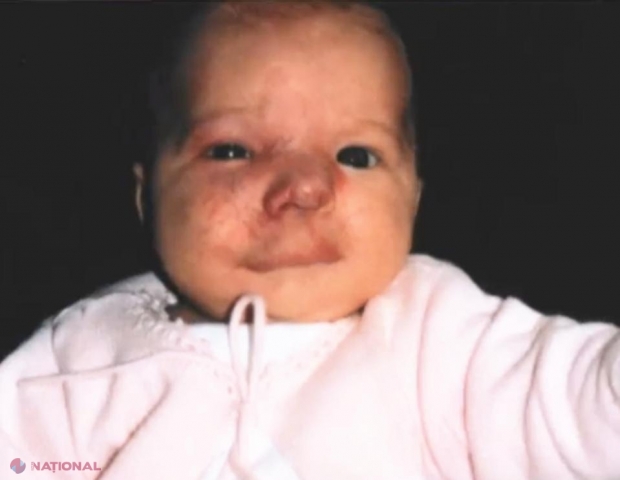 FOTO // Boala rară care i-a desfigurat fața unei fetițe