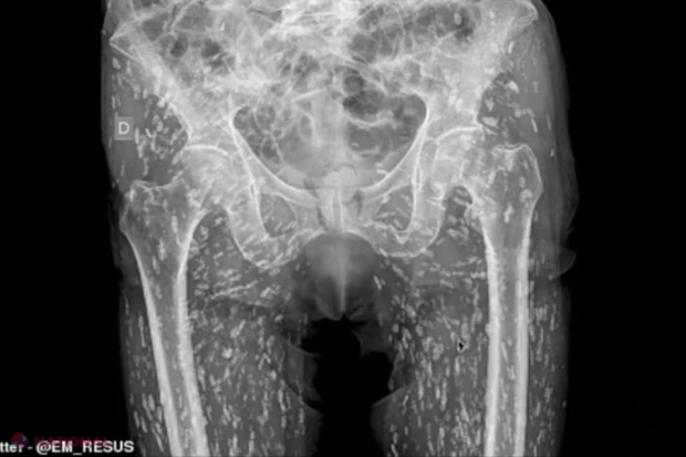 Imagine șocantă: Bărbat infestat cu ouă de tenie în tot corpul de la acest aliment​. Tratament și prevenție