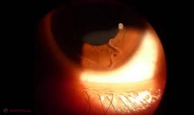 VIDEO ŞOCANT // Boala în care viermele îţi iese prin ochi 