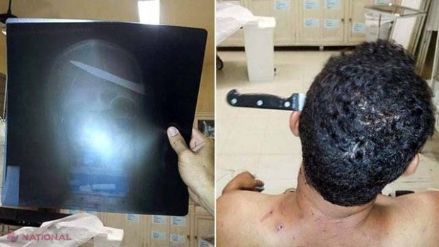 FOTO // A venit singur la spital... cu UN CUȚIT ÎNFIPT ÎN CAP!