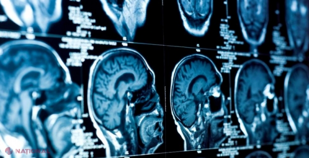 O boală misterioasă a creierului îi îngrijorează pe medicii din Canada