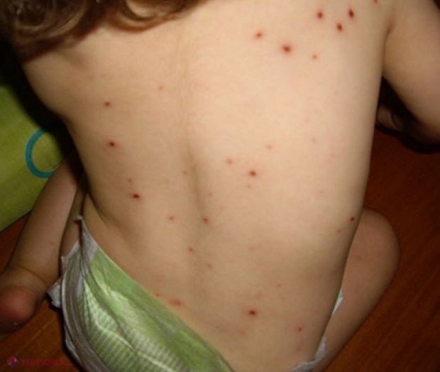 ALARMANT // Zeci de cazuri de RUJEOLĂ, înregistrate în luna mai în R. Moldova: Victimele NU fusese vaccinate împotriva acestei boli