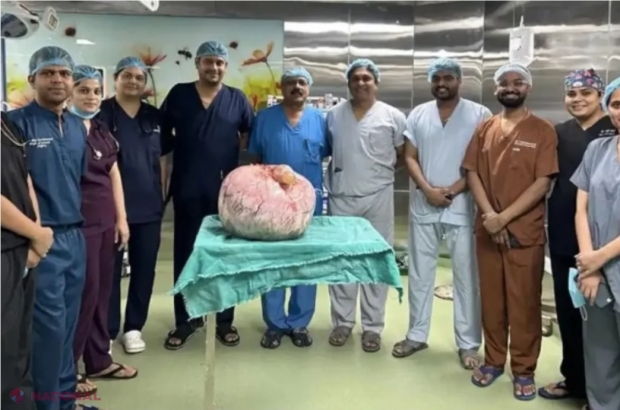 FOTO // Tumoră gigant de 15 kilograme, extirpată din abdomenul unei femei de doar 49 de kilograme