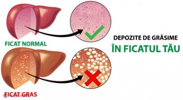 O bacterie provoacă boala ficatului gras şi te poate îmbăta, chiar dacă nu consumi alcool