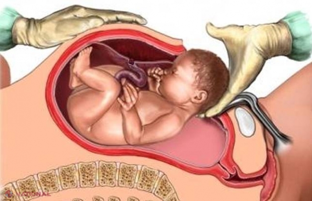 Ce se întâmplă cu BEBELUŞII născuţi prin CEZARIANĂ