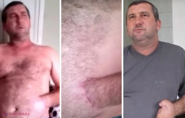 VIDEO // I-au cusut mâna în stomac. Explicația medicului care l-a operat