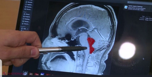 Un bărbat care a suferit dureri de cap ani de zile a descoperit că avea viermi care trăiau în creierul lui