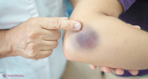 Boala care lasă vânătăi: O treime dintre bolnavii de HEMOFILIE din R. Moldova sunt copii