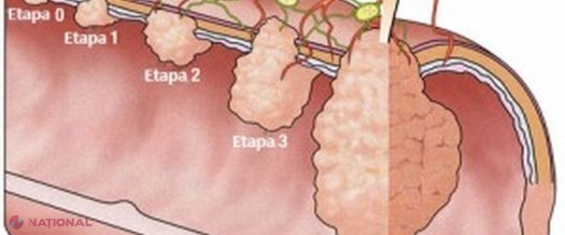 MOARTEA începe în colon! Cum îți CUREȚI colonul ca să eviți 90% din boli