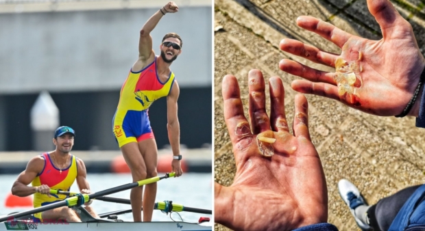 Suferințele din spatele unei MEDALII olimpice. Poza cu palmele medaliatului Ciprian Tudosă, dovada sacrificiilor uriașe