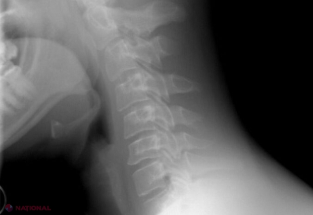 Implant revoluționar care ajută la regenerarea naturală a oaselor