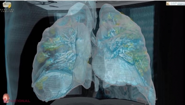 VIDEO // Cum arată plămânii unui pacient bolnav de COVID-19. Imagini 3D cu leziunile produse de coronavirus. „Oamenii să ia asta în serios”