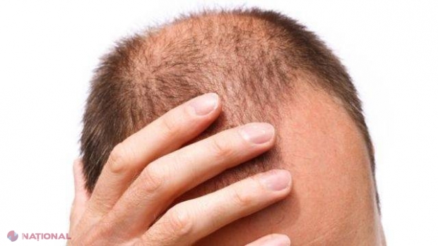 Adio, transplant de păr. Cercetătorii au descoperit leacul pentru chelie!