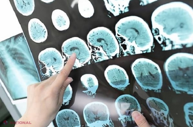 Peste 10 mii de cetățeni ai R. Moldova suferă anual un accident vascular cerebral: Cum trebuie să acționați când observați o persoană cu simptomele acestei afecțiuni