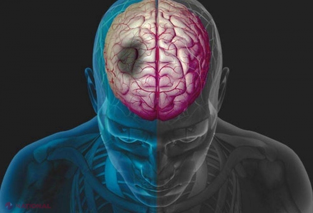 Semnele care anunță că ești pe cale să faci un atac cerebral! Uite la ce trebuie să fii atent 