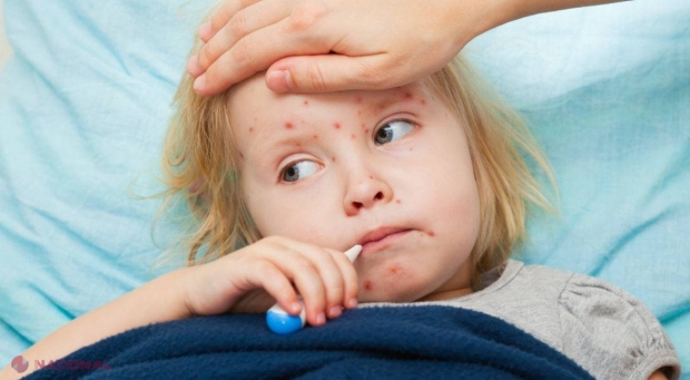 Epidemia de rujeolă ar putea ajunge în R. Moldova? Ministerul Sănătății se declară ÎNGRIJORAT