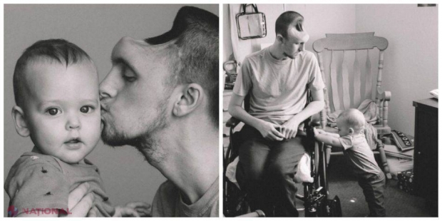 Bărbatul fără sfert de cap. Ce a băut acest tătic de medicii au fost nevoiţi să îi elimine o parte din creier. O poveste reală şi emoţionantă