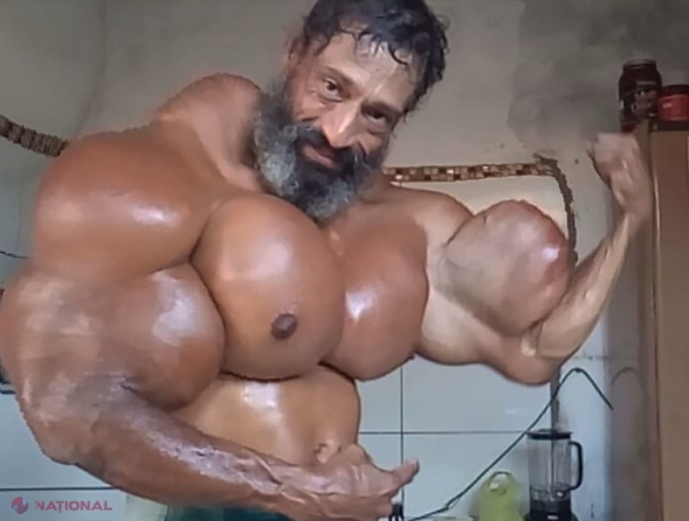 FOTO, VIDEO // Şi-a injectat ULEI în corp pentru a arăta ca Schwarzenegger, iar acum riscă să-i fie amputate membrele! E şocant cum poate arăta acest culturist 