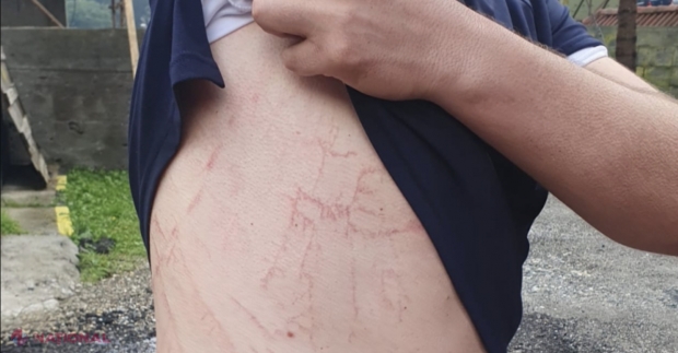 FOTO // Cum arată semnele lăsate de FULGER pe corpul unui om? Ghid practic de supraviețuire pe timp de furtună: „Nu fugiți, pentru că apare golul de potențial care atrage fulgerul”