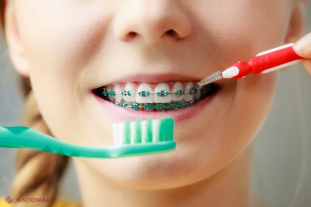 Explicațiile medicului ORTODONT: Cinci semne vizibile că avem nevoie de aparat dentar