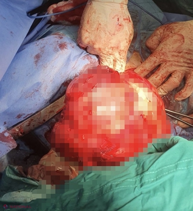 SUCCES // O TUMOARE GIGANTĂ, de aproape cinci kilograme, extrasă din cutia toracică a unei femei: Operația efectuată de chirurgii de la SCR „Timofei Moșneaga” a durat trei ore