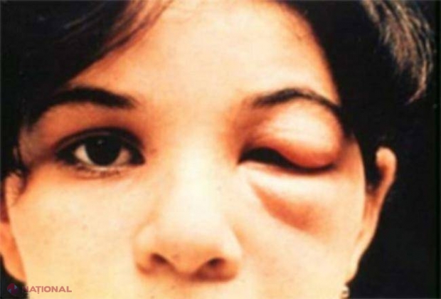 Noua SIDA? - KISSING BUG, parazitul care a infectat deja peste 300 000 de persoane