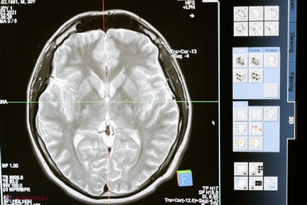 Speranțe pentru tratarea cancerului cerebral: Cercetătorii au descoperit un medicament 100% eficient