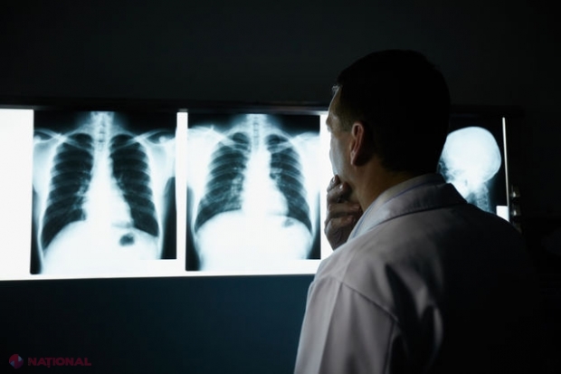 Cum poți face cancer la plămâni la 31 de ani, fără să fumezi o țigară